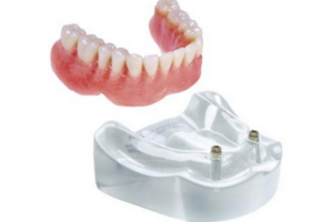 Implant Over Dentures Implant Over Dentures
