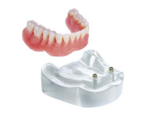 Implant Over Dentures